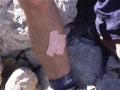James' injuries after the fall